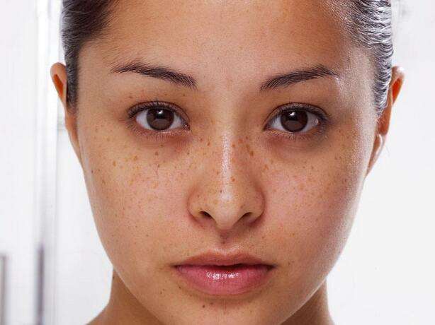 年纪轻轻就有蝴蝶斑, 八成是它在搞鬼