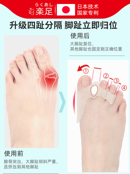 엄지 valgus 교정기, 큰 발 뼈, 여성을위한 발가락 교정 분리 장치, 웨어러블 신발, 실리콘 발가락 교정기, 엄지 valgus 교정기, 큰 발 뼈, 여성을위한 발가락 교정 분리 장치, 웨어러블 신발, 실리콘 발가락 교정기,