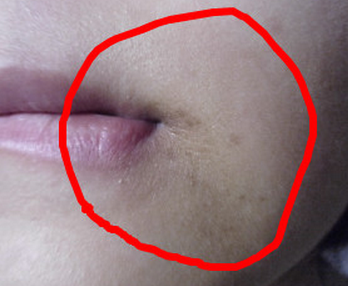 嘴巴周围黑黑的究竟是什么惹的祸