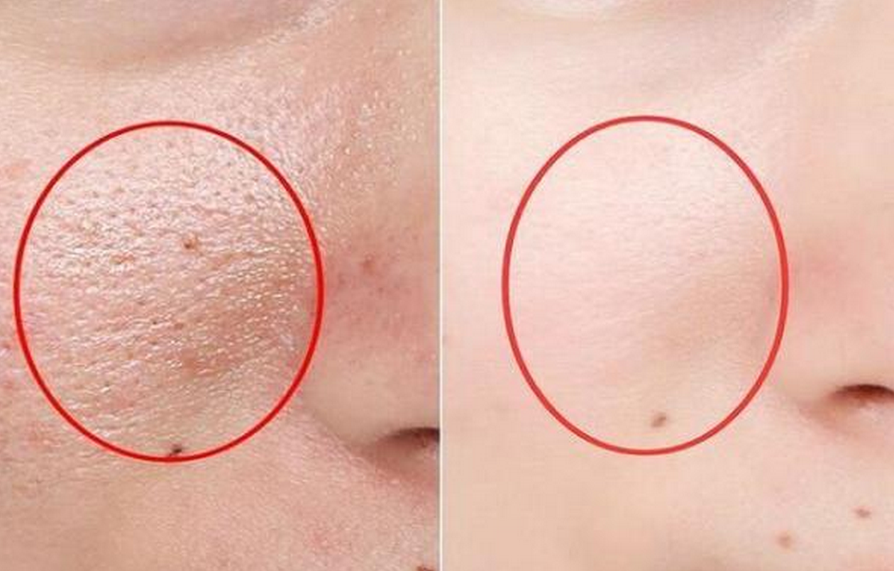 脸上有螨虫不要慌,每天一勺粉除螨还美白