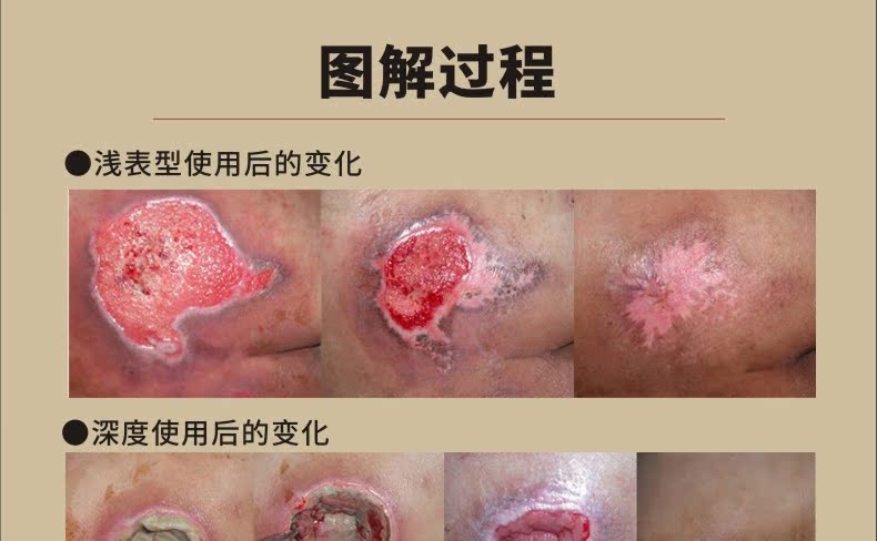 三君堂老人护理膏 压疮膏 玉红膏 促伤口压疮愈合祛去