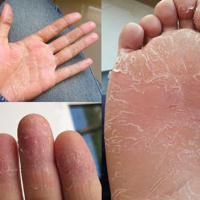 【买2送1】季节性手足脱皮干燥开裂脚后跟龟裂干裂防皲裂止痒膏