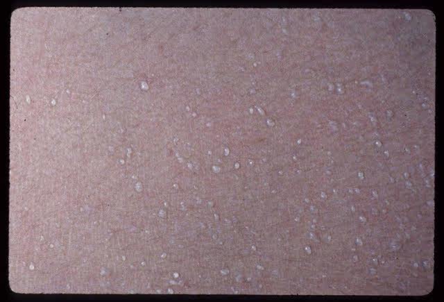 夏季防痱子有招了!