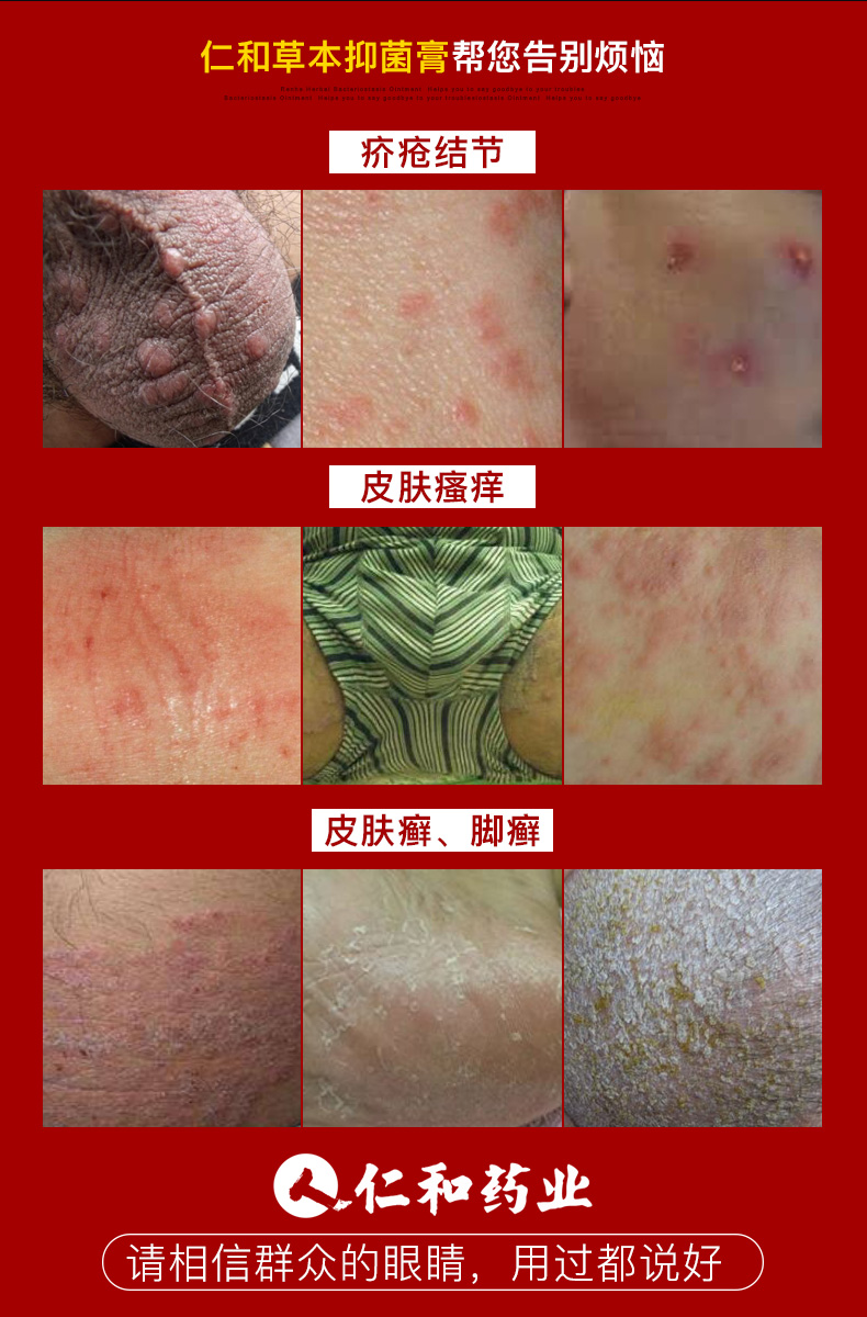 湿疹止痒去根疥疮大腿内侧阴囊外阴肛门屁眼瘙痒男女