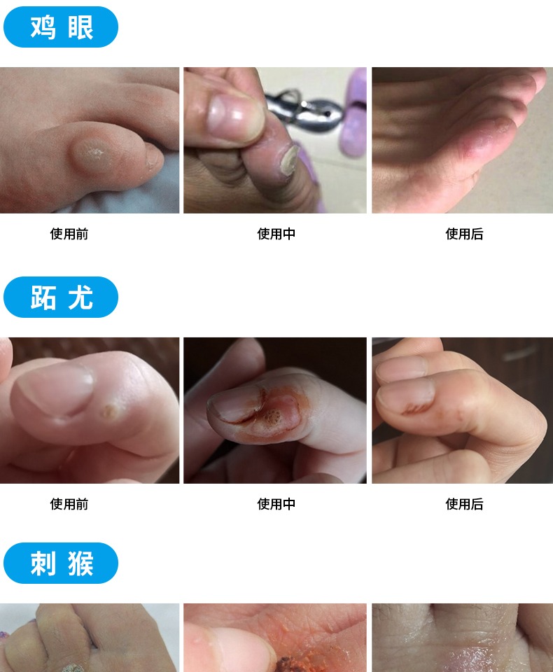 鸡尤茧尤净去鸡眼神器专用肉刺猴贴子跖尤膏去除手足脚部老茧死皮_铁