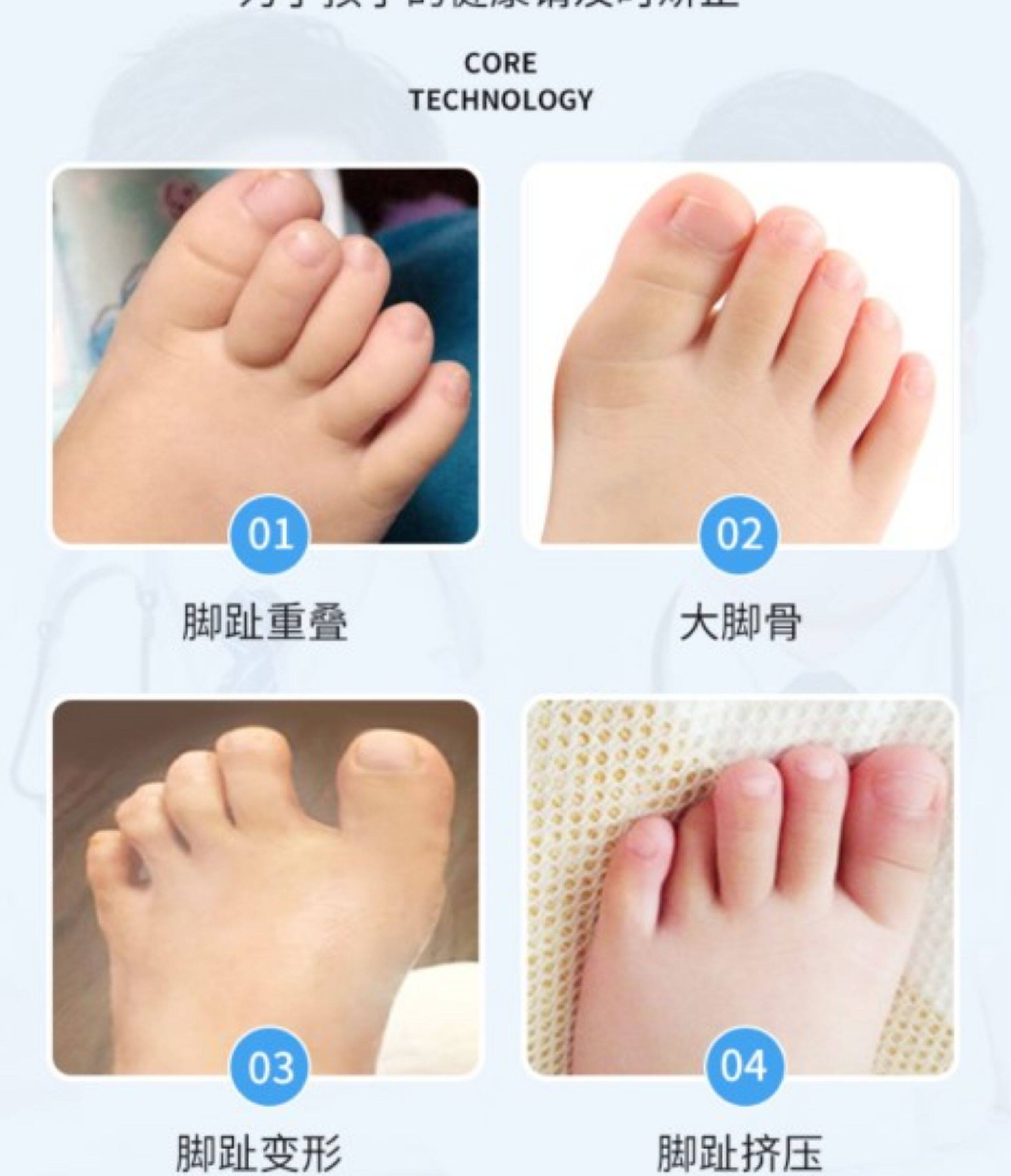 日本婴儿脚趾矫正器儿童专用宝宝重叠分趾器纠正神器拇指外翻小孩
