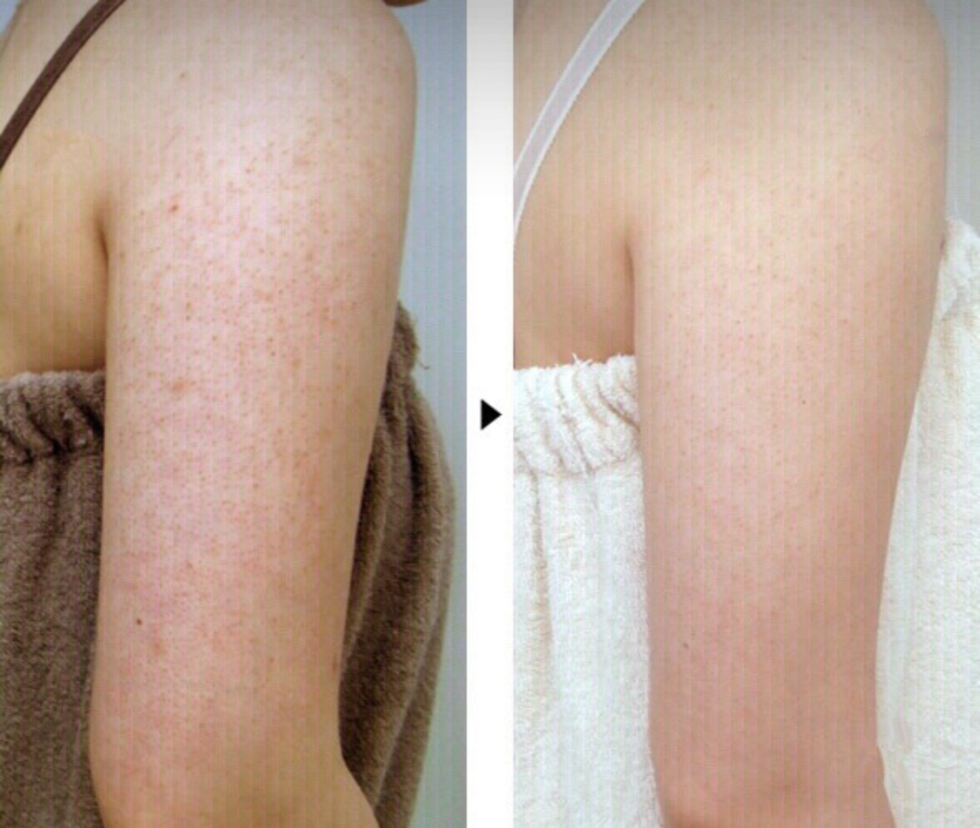 但养成勤去角质对鸡皮肤一定会有缓解哦