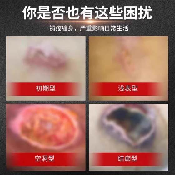 노인과 엉덩이를위한 침대 크림 외부 썩은 궤양의 약은 노인에 놓여있는 침대와 노인과 피부 스페셜 크림을위한 썩은 피부에 썩은 썩은 궤양 약 노인과 엉덩이를위한 침대 크림 외부 썩은 궤양의 약은 노인에 놓여있는 침대와 노인과 피부 스페셜 크림을위한 썩은 피부에 썩은 썩은 궤양 약