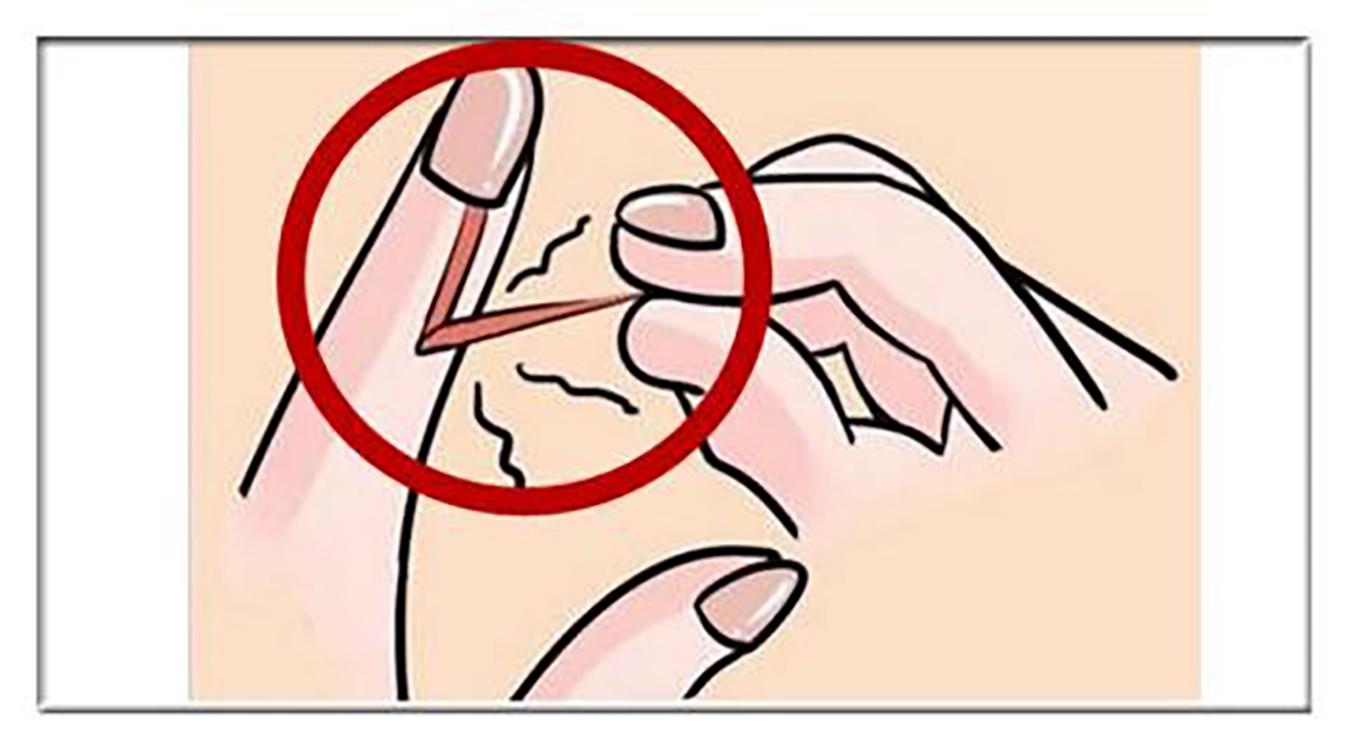 手上长倒刺,你可别手贱去撕拔