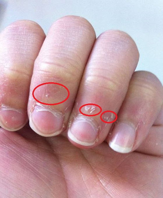 手指上出现这些倒刺,究竟怎么回事?-趣美搭