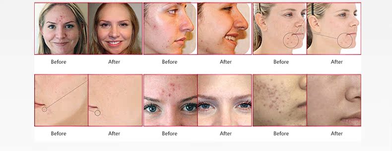 LightStim红蓝光祛痘美容仪套装进口彩光多功