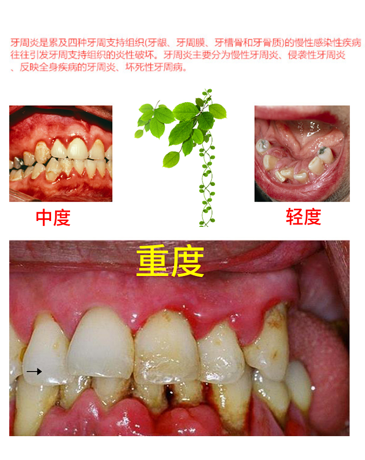牙科武汉朗力牙周软膏 牙周康膏与派力奥一样 一只_双