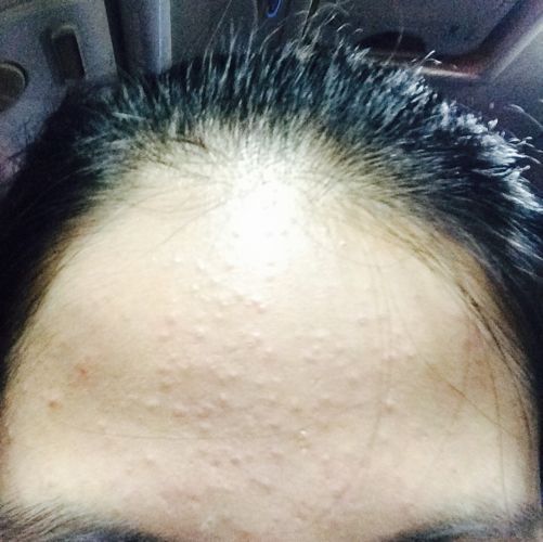 闭口粉刺是什么鬼如何才能把它搞定