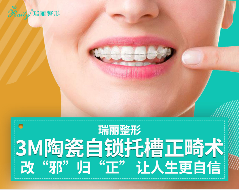 瑞丽整形 3m陶瓷自锁托槽正畸 矫正牙齿方便快捷 舒适有效