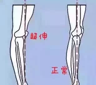如何避免膝盖超伸?一张图看明白 | 问答