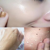 Little red book with the same model to buy 2 to get 1 ~ to face garbage horny clean pores to brighten skin color for men and women