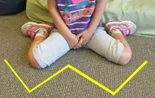 第一种不良坐姿:w型坐姿