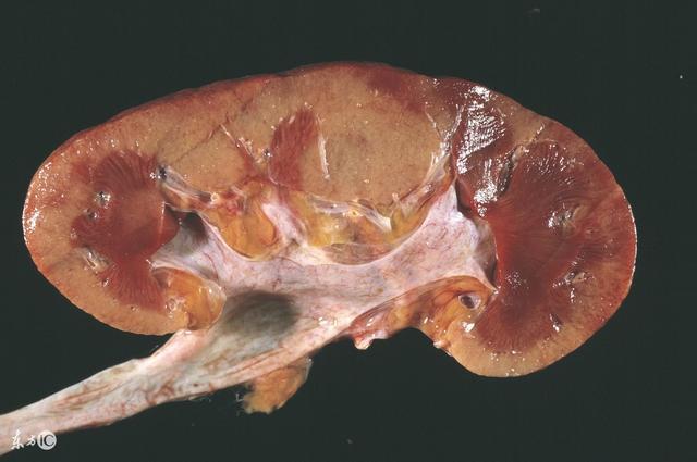 困倦乏力:肾脏受损