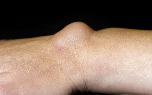 预防癌症,注意身上这4个部位出现肿块