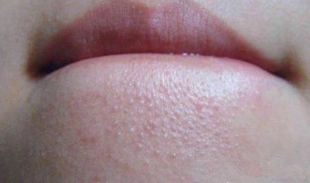 下巴上凹凸不平的小疙瘩是啥?能消吗? - 天猫精选