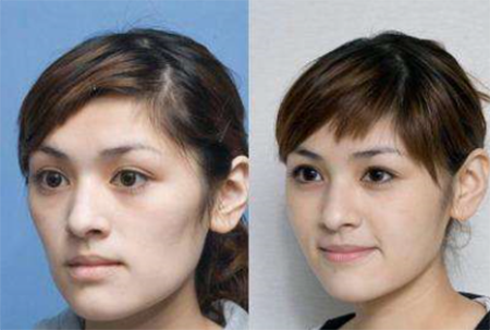 而第二张是苹果肌丰润的脸型明显感觉人年轻了10岁