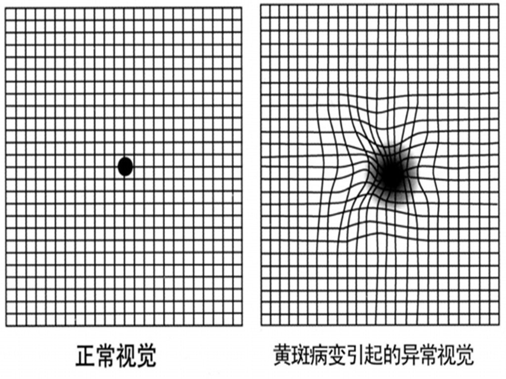 正常情况; 如果看到网格模糊,变形或颜色异常时,就很有可能患上了黄斑