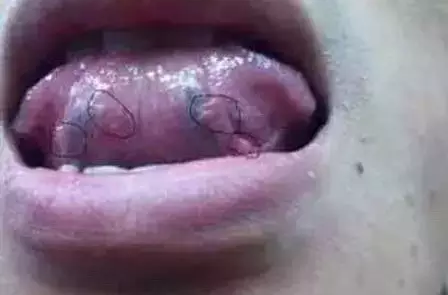 舌下有两条静脉血管静静地流淌,正常情况下这两条静脉血管隐约可见