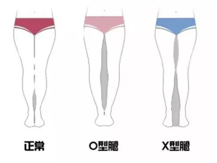 正常腿型