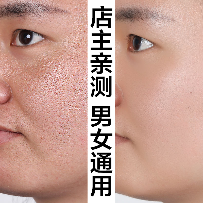 去粉刺的方法_激光祛痘痘粉刺方法_碱面去黑头粉刺方法