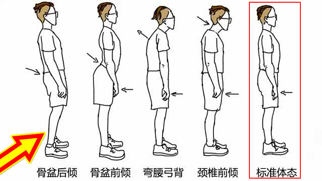 人体侧面驼背图片