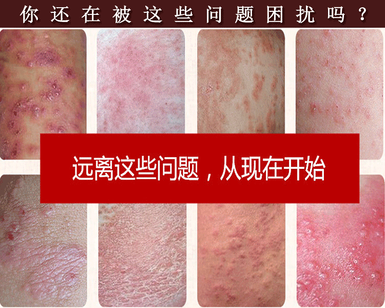 藏药百毒王成人芙颜堂草本乳膏祛毒止痒皮肤大腿内侧阴囊湿诊软膏