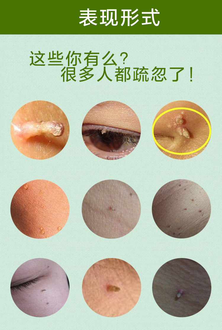 正品众乐康健珍草克忧霜止尤灵克疣液扁平忧手尤丝状疣草本克疣霜