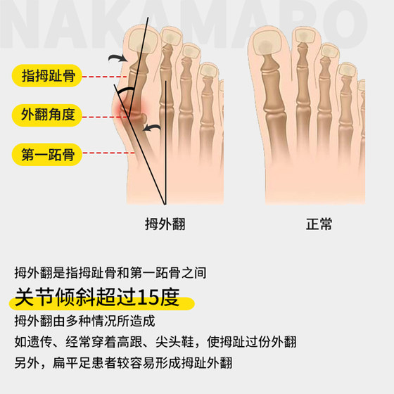발가락 교정 운동 발가락 장력 밴드 대형 발 뼈 유연한 탄성 밴드 엄지 valgus 보정 훈련 장치 발가락 교정 운동 발가락 장력 밴드 대형 발 뼈 유연한 탄성 밴드 엄지 valgus 보정 훈련 장치