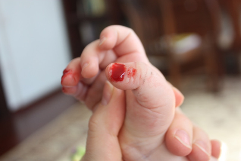 宝宝手上作妖的倒刺!是缺少维生素吗?