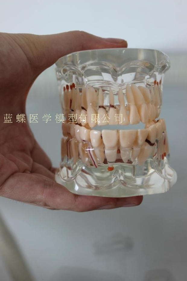 高级透明 全口病理牙模型 医学教学 综合病理牙齿模型