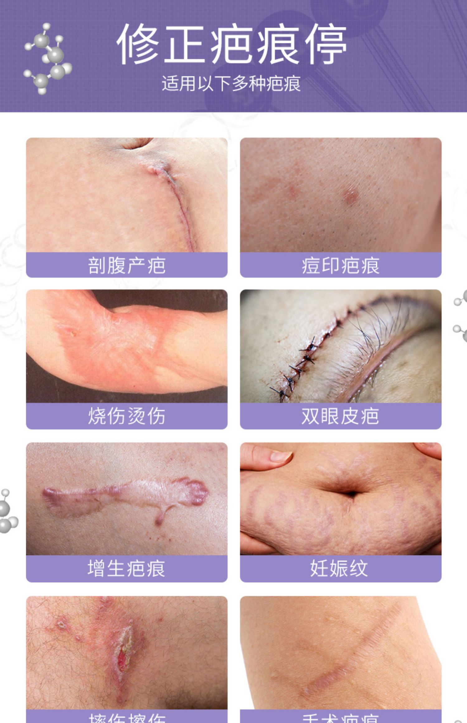 修正去疤痕正品伤疤祛疤膏凹凸疤痕修复手术除疤痕贴痘印烫伤医用