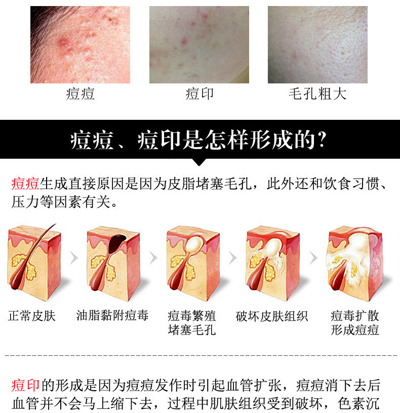 荘典三绝痘根尽终极版套盒膏霜痘印消精华素正品防伪