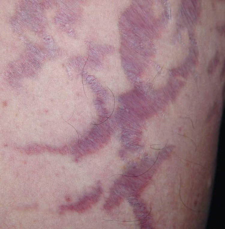 [亲子油妊娠纹护理]孕妇专用防止去妊娠纹产后预防消除去除月销量3件