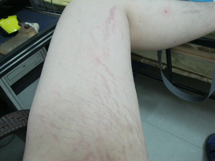 肥胖纹,萎缩纹都能去!