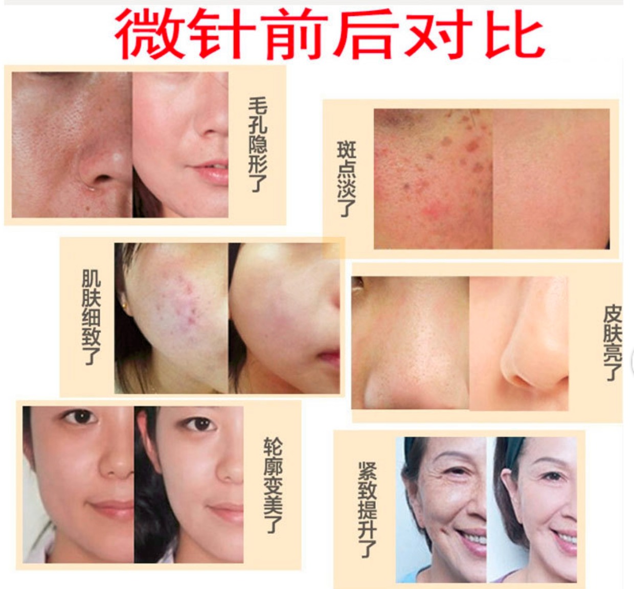[小兔精品小屋化妆,美容工具]痘印痘坑滚针美容微针仪器滚轮粉刺闭口