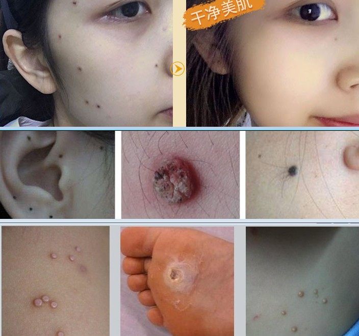 zoko赘克正品清赘五慈膏