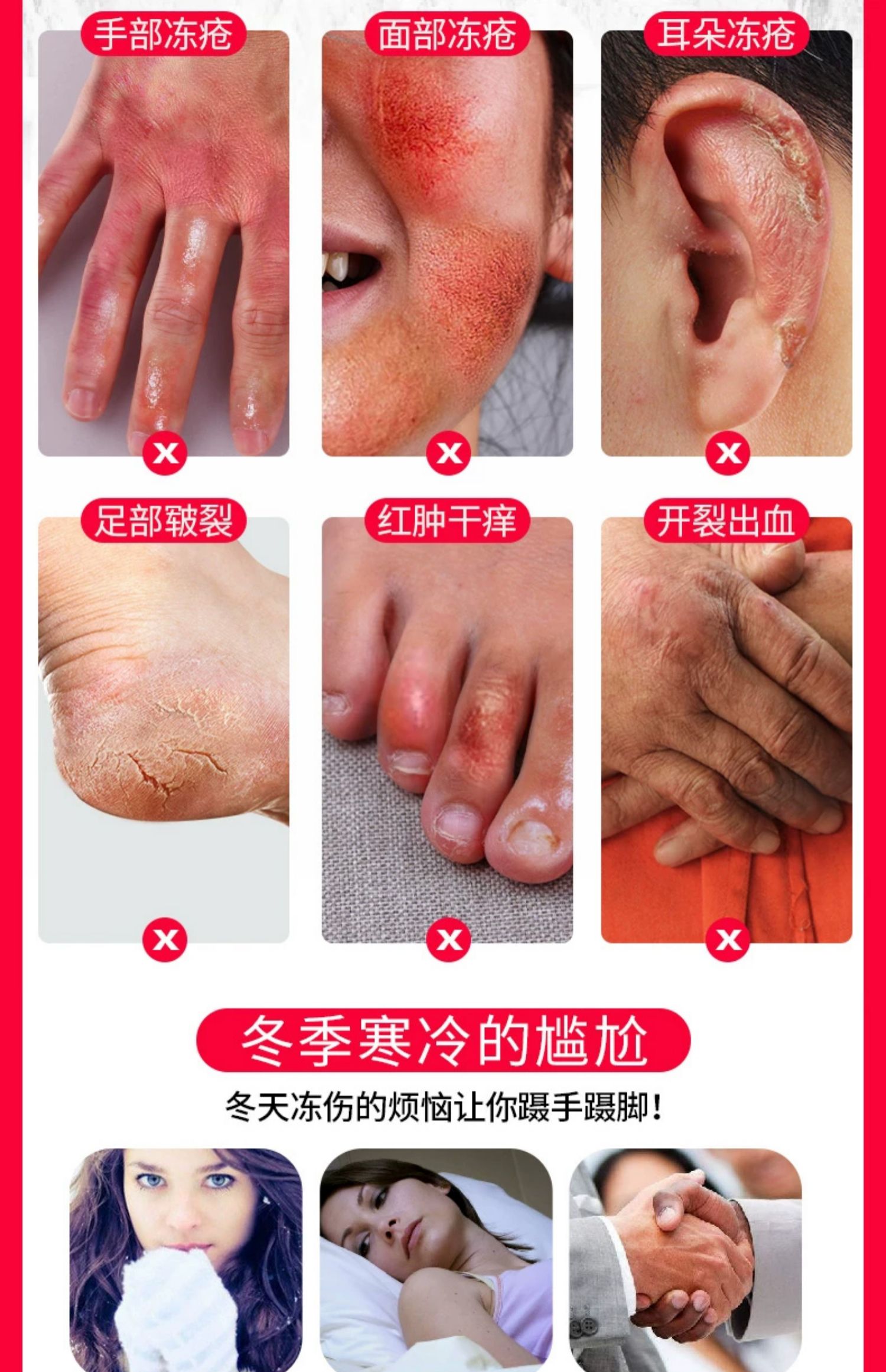 云南本草冻疮膏止痒冻伤膏