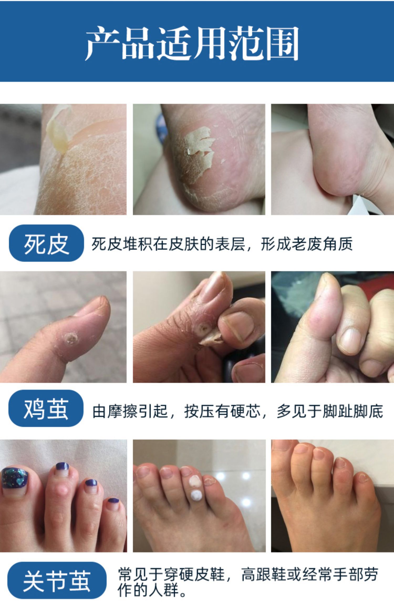 茧克去老茧脚茧去除专用神器手茧子上死皮关节脚趾软化剂膏贴脚垫_爱