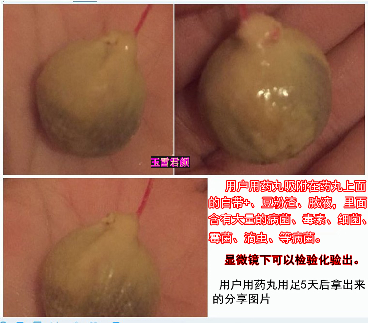 玉雪君颜阴道清毒宝白带异味私处护理抑菌清宫丸正品妇科凝胶