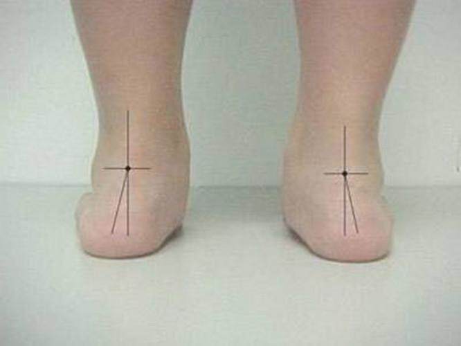 去购买 推荐理由:高弓足专用的矫正器,很有效!