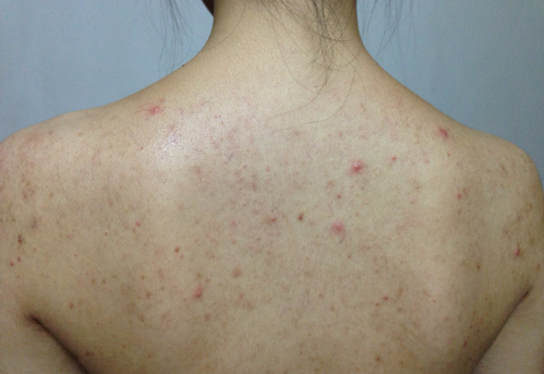 性感露背装不敢穿,可能是这些细节使你长痘?