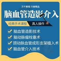 Cerebral vascular interventional angiography diagnosis and treatment technology Carotid Angioplasty Stent implantation Aneurysm Embolization imaging