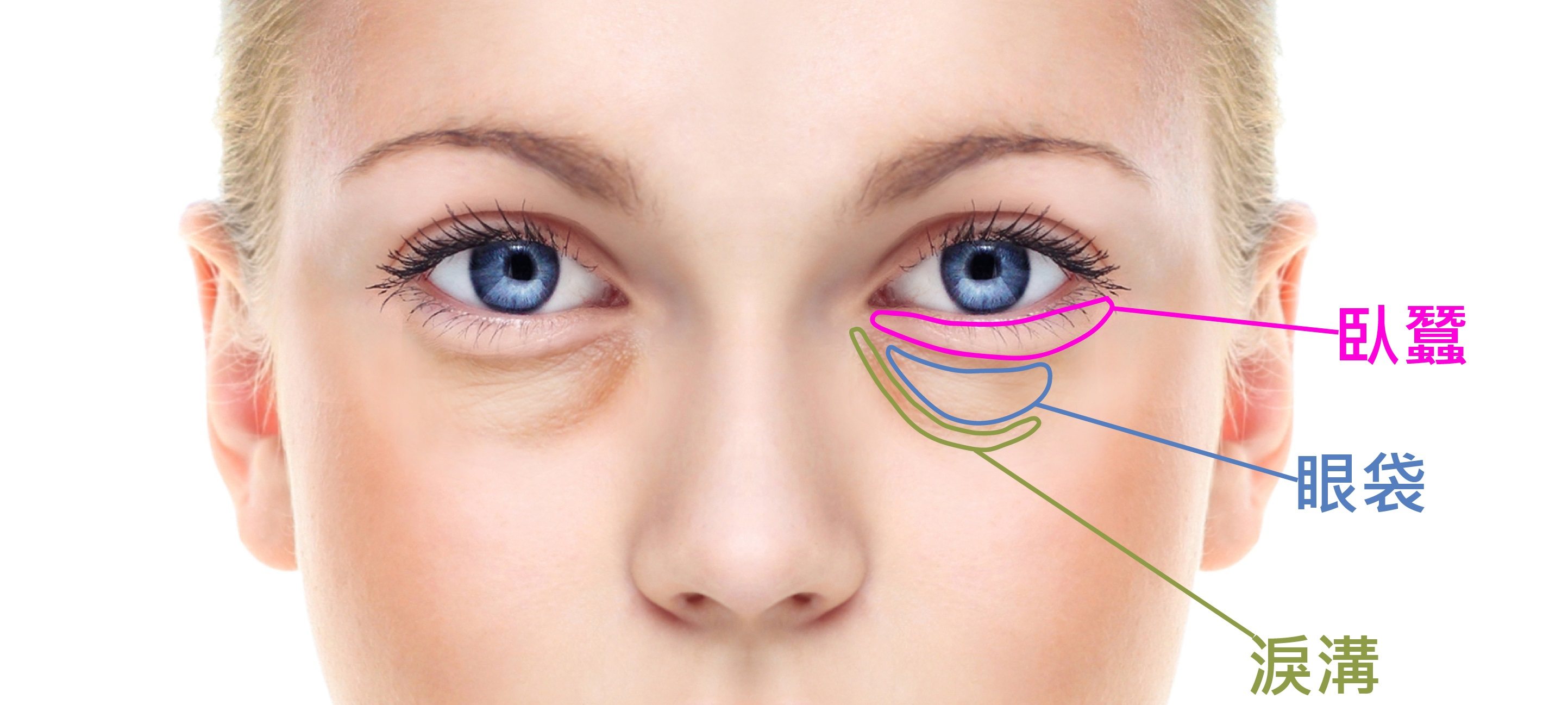 下眼皮浮肿就是眼袋,眼袋也分为先天性和后天性.