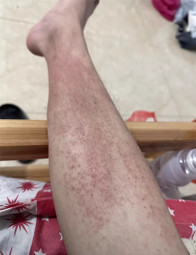 冬天腿痒换季天气冷小腿皮肤痒腿上起疙瘩长红点皮炎