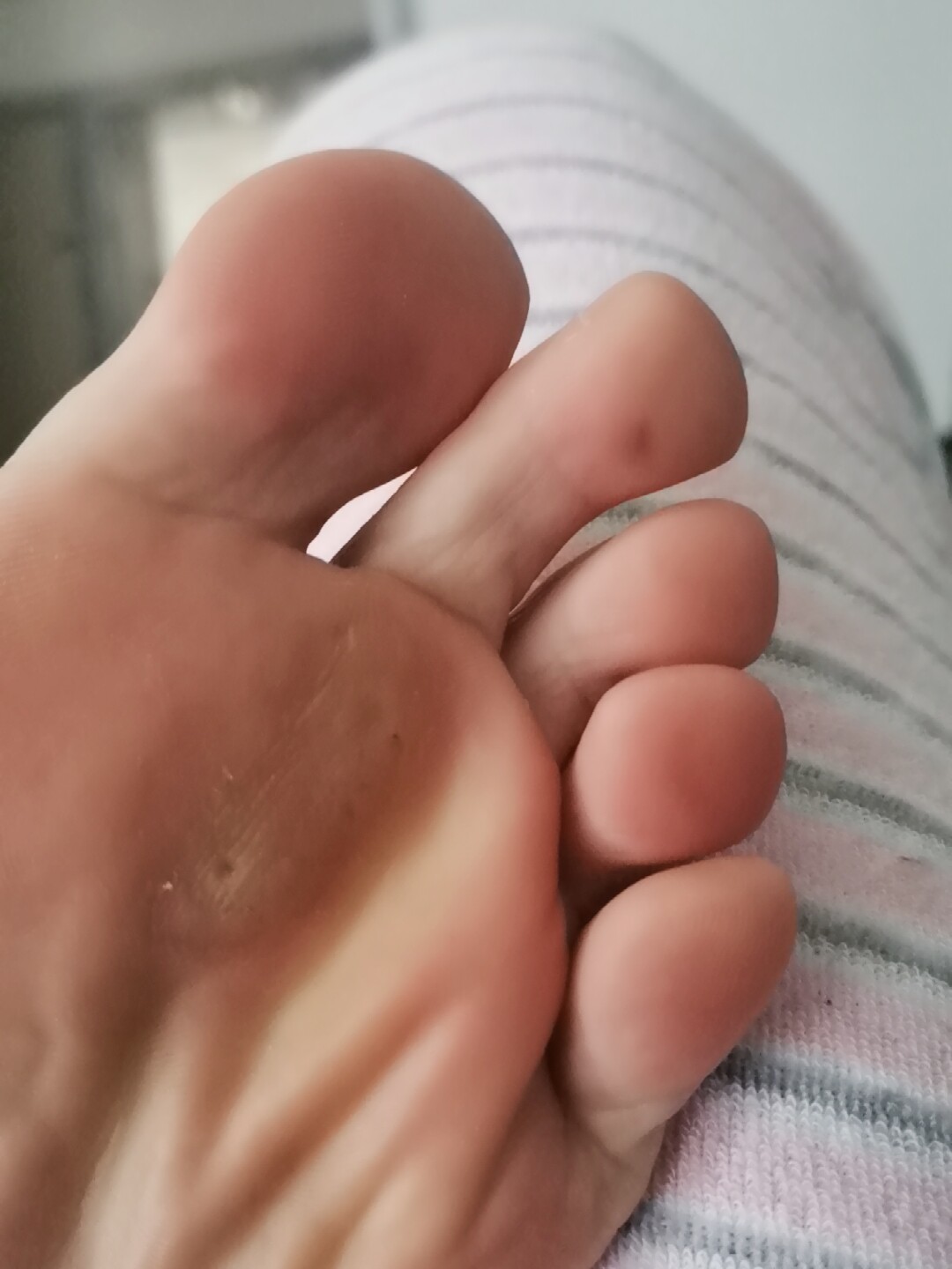 鸡眼专用膏鸡眼脚底祛脚垫脚茧厚茧鸡眼祛肉刺猴子